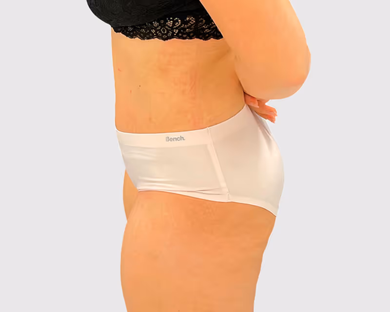Abdominoplasty Case 8 after view