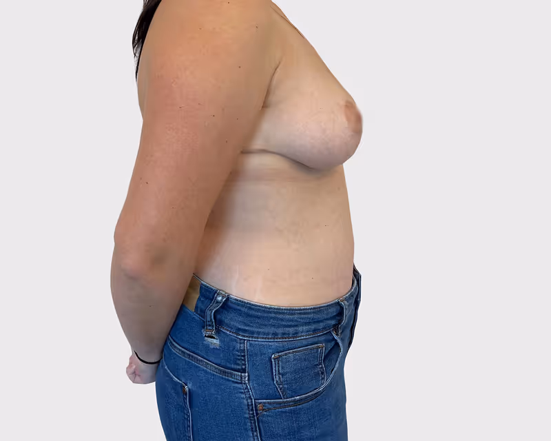 Breast Lift Case 4 after view
