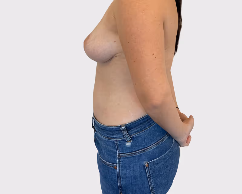 Breast Lift Case 4 after view