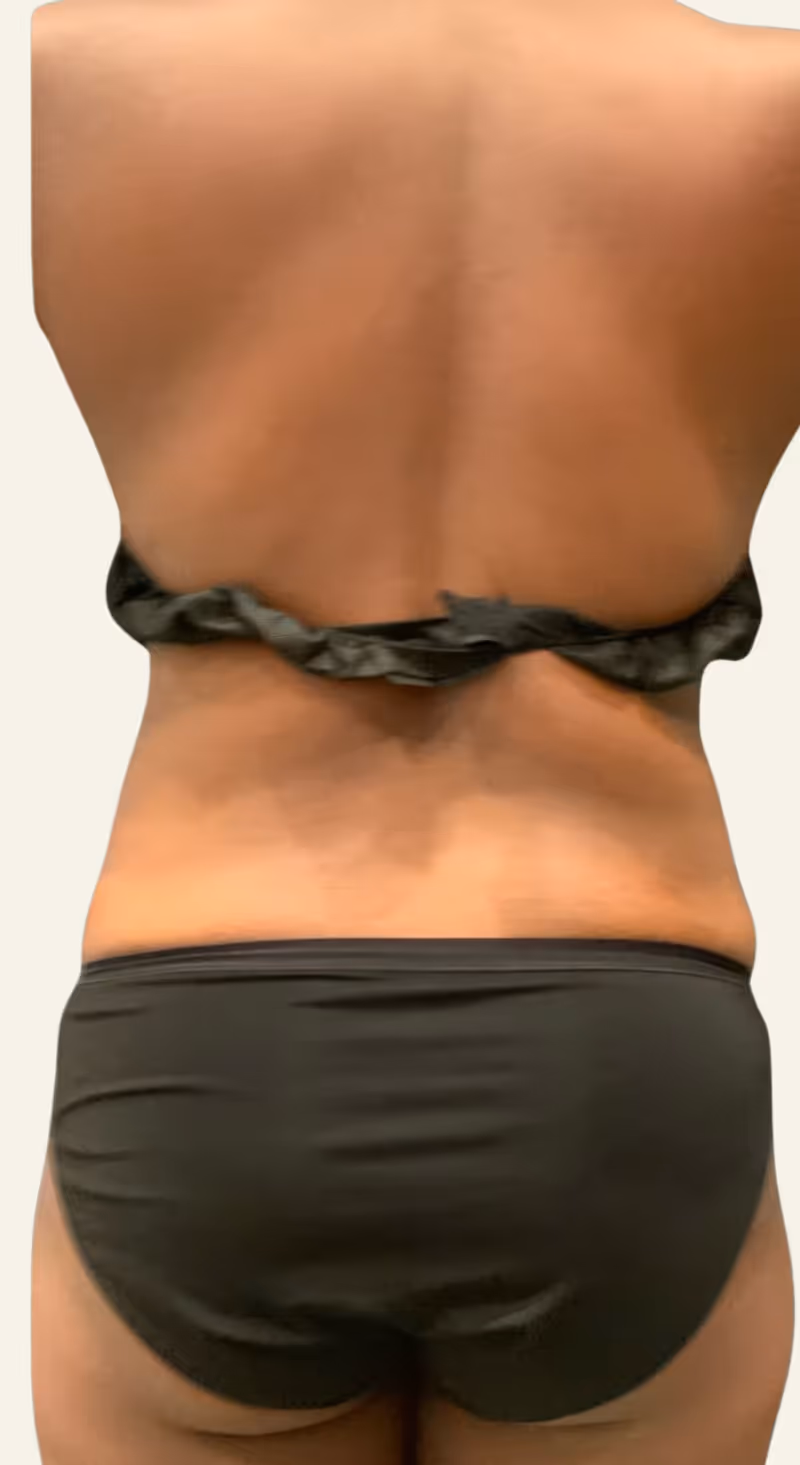 Liposuction Case 1 after view