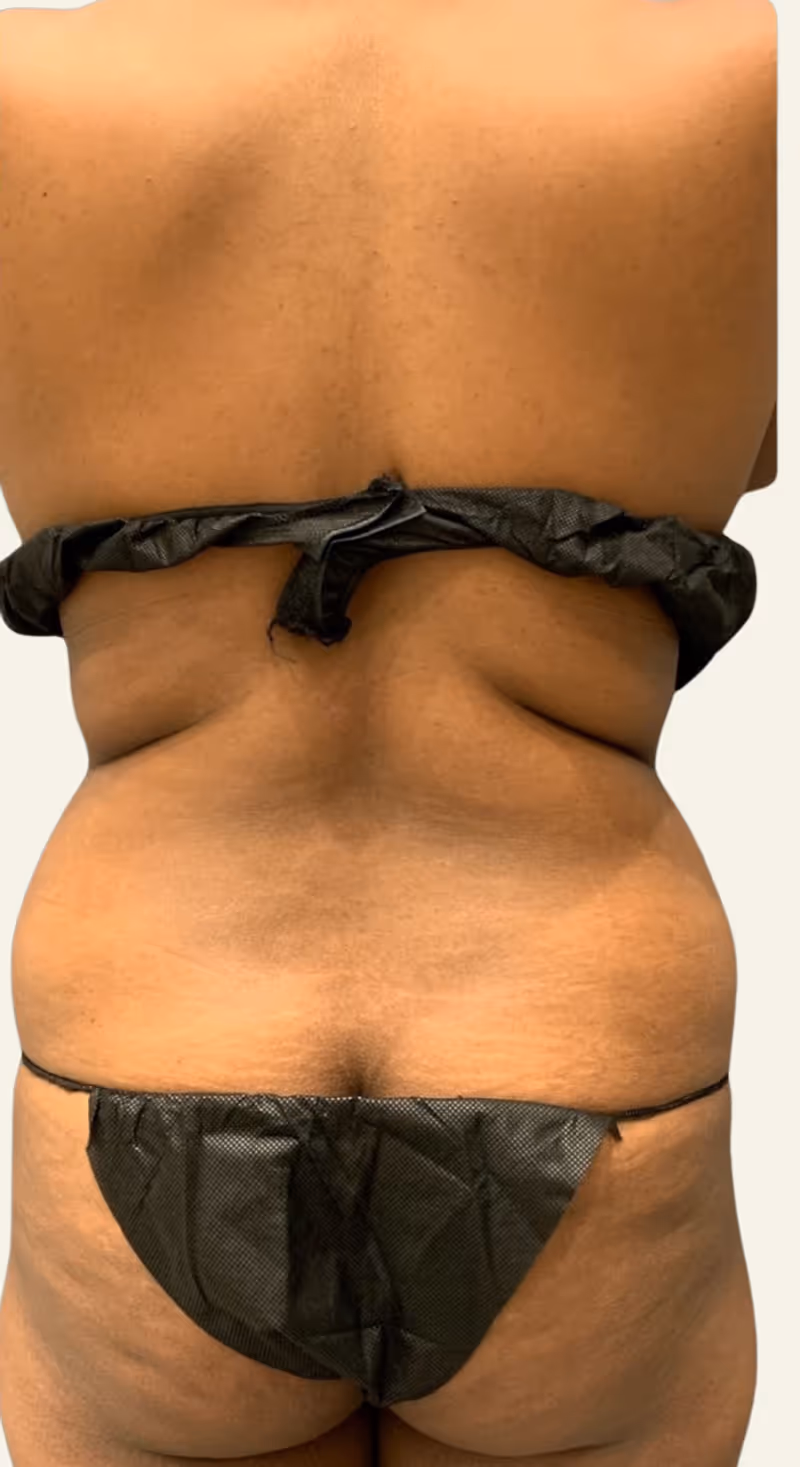 Liposuction Case 1 before view