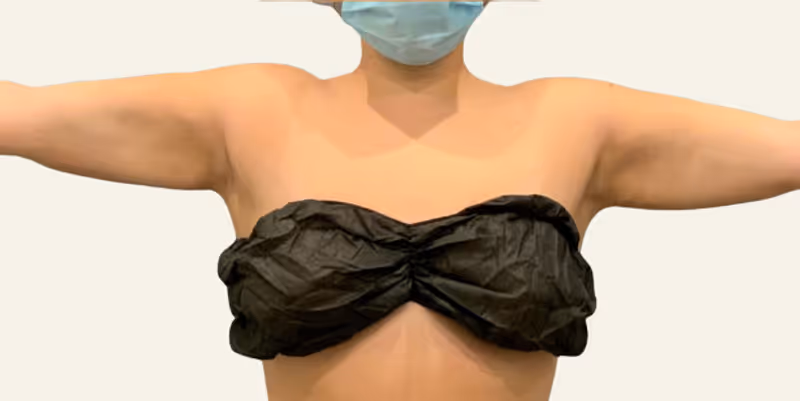 Liposuction Case 10 after view