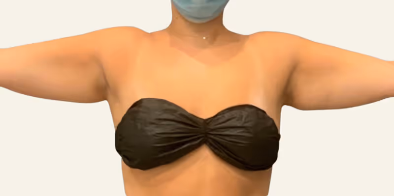 Liposuction Case 10 before view