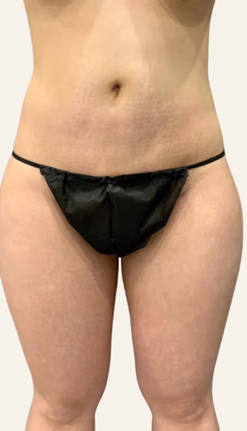 Liposuction Case 12 after view