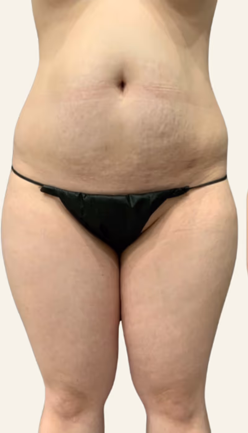 Liposuction Case 12 before view