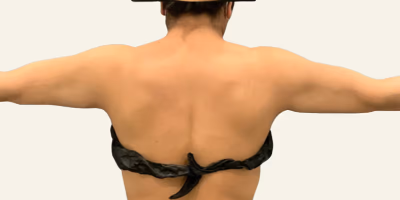 Liposuction Case 13 after view