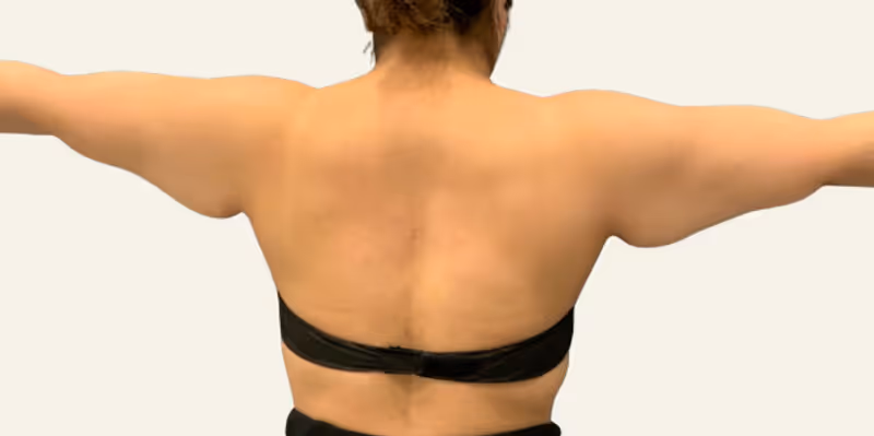 Liposuction Case 13 before view