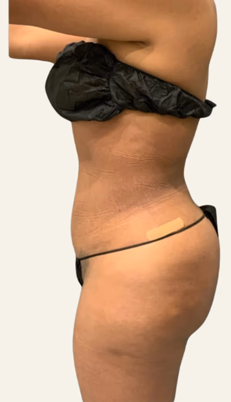 Liposuction Case 14 after view