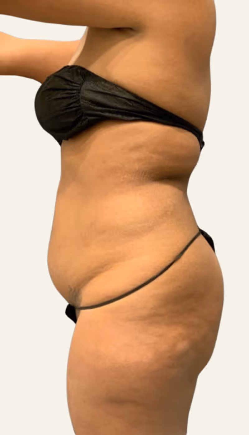 Liposuction Case 14 before view