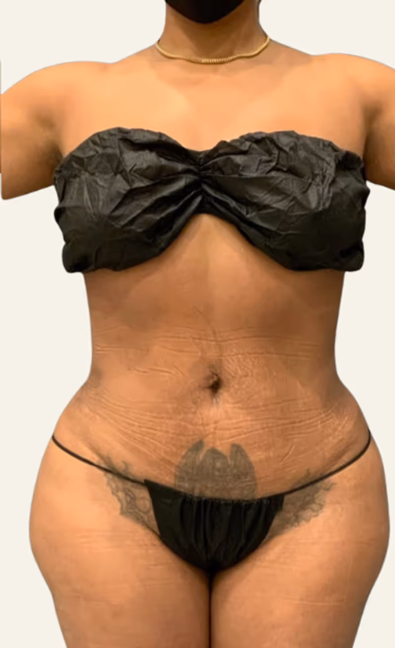 Liposuction Case 15 after view