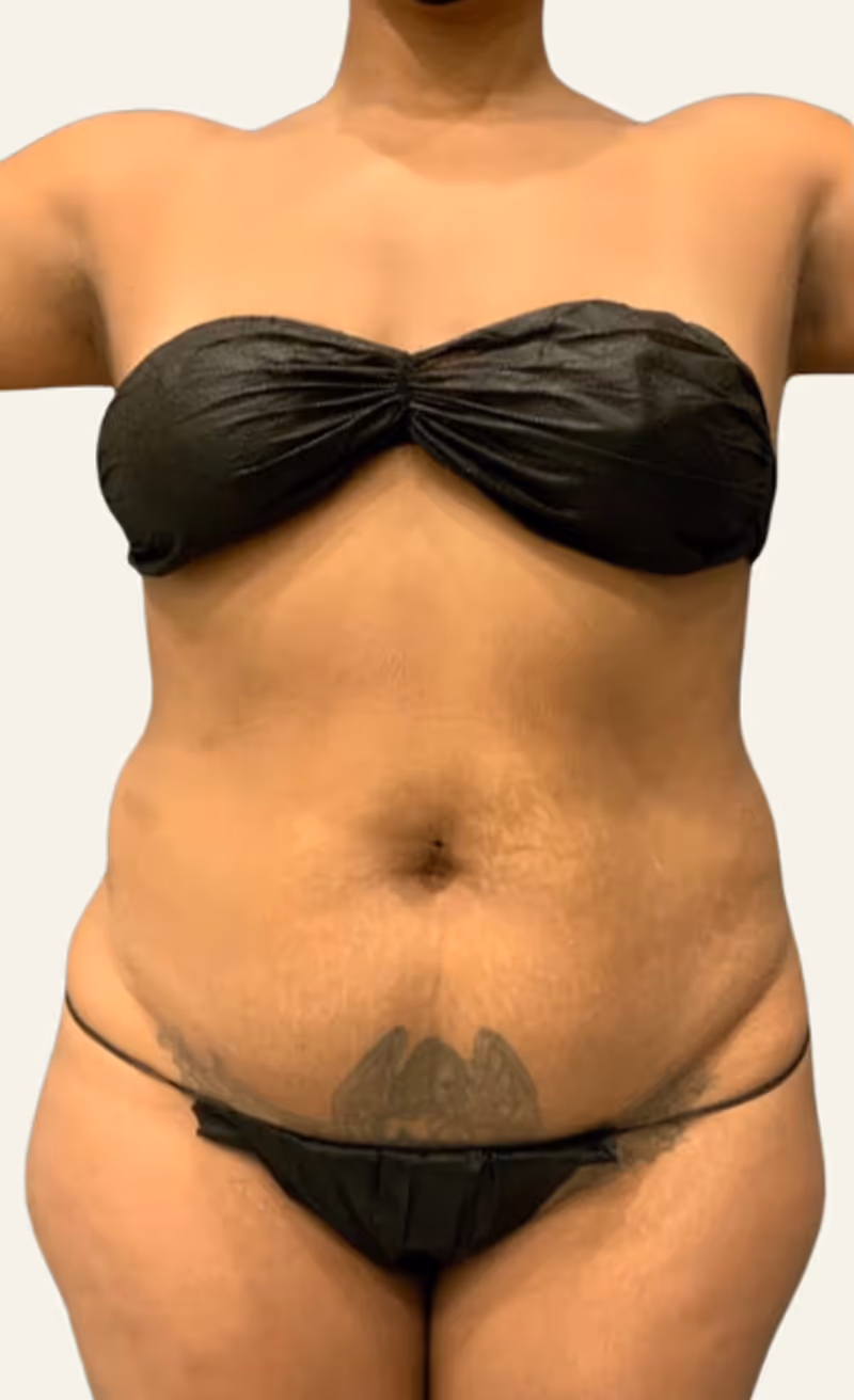 Liposuction Case 15 before view