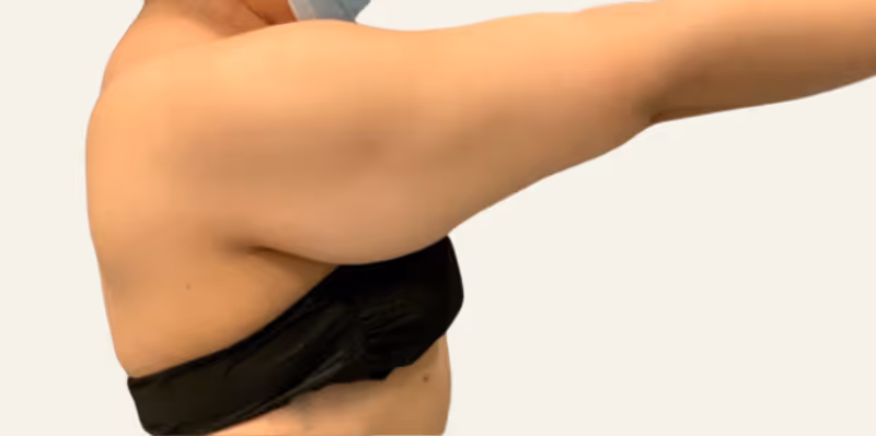 Liposuction Case 16 before view