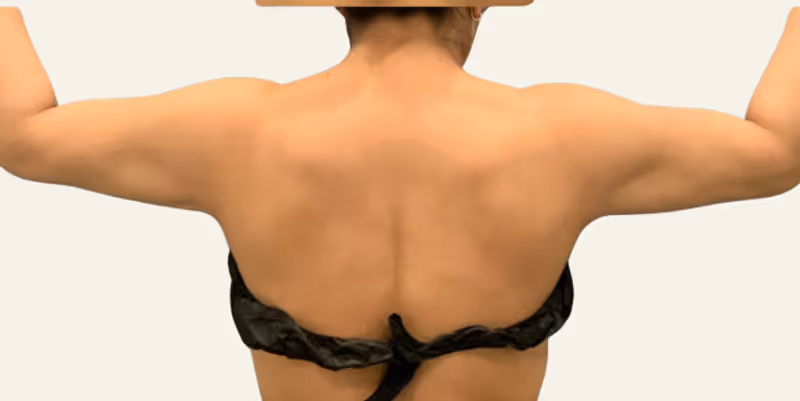 Liposuction Case 17 after view