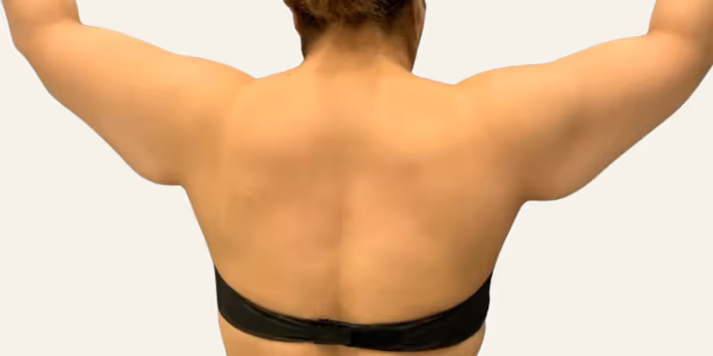 Liposuction Case 17 before view