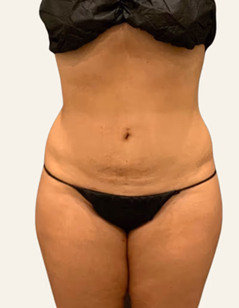 Liposuction Case 18 after view