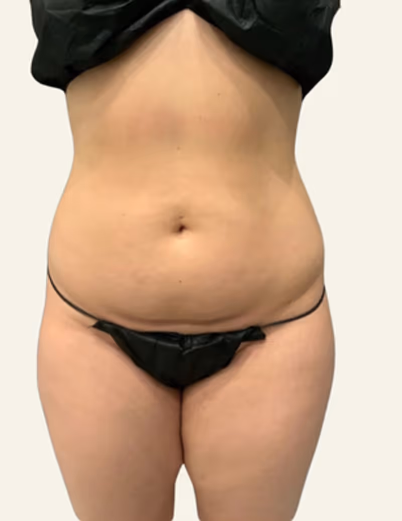 Liposuction Case 18 before view