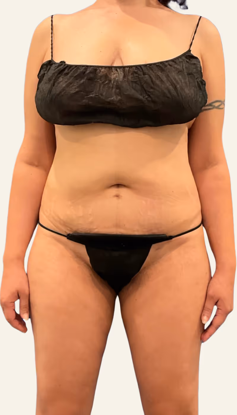 Liposuction Case 19 after view
