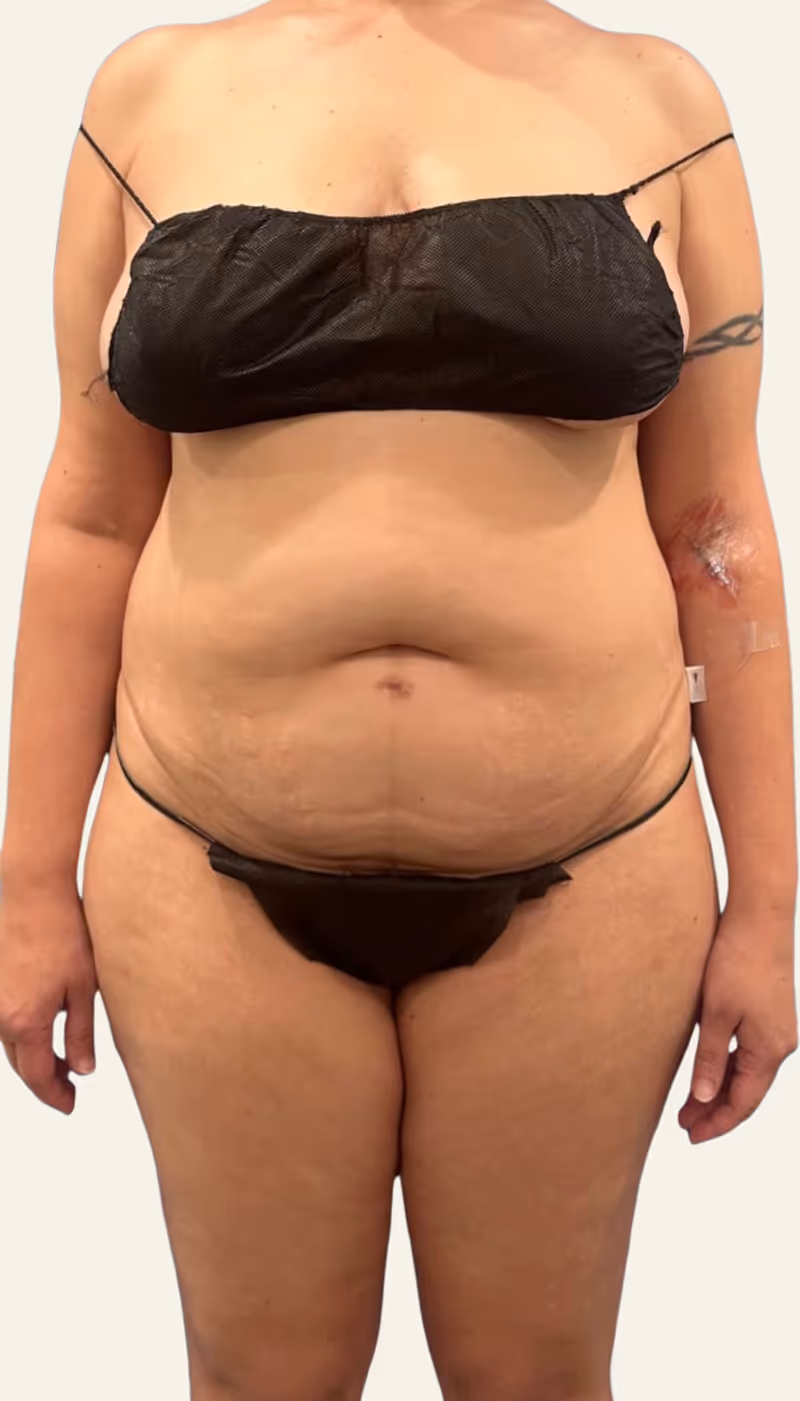 Liposuction Case 19 before view