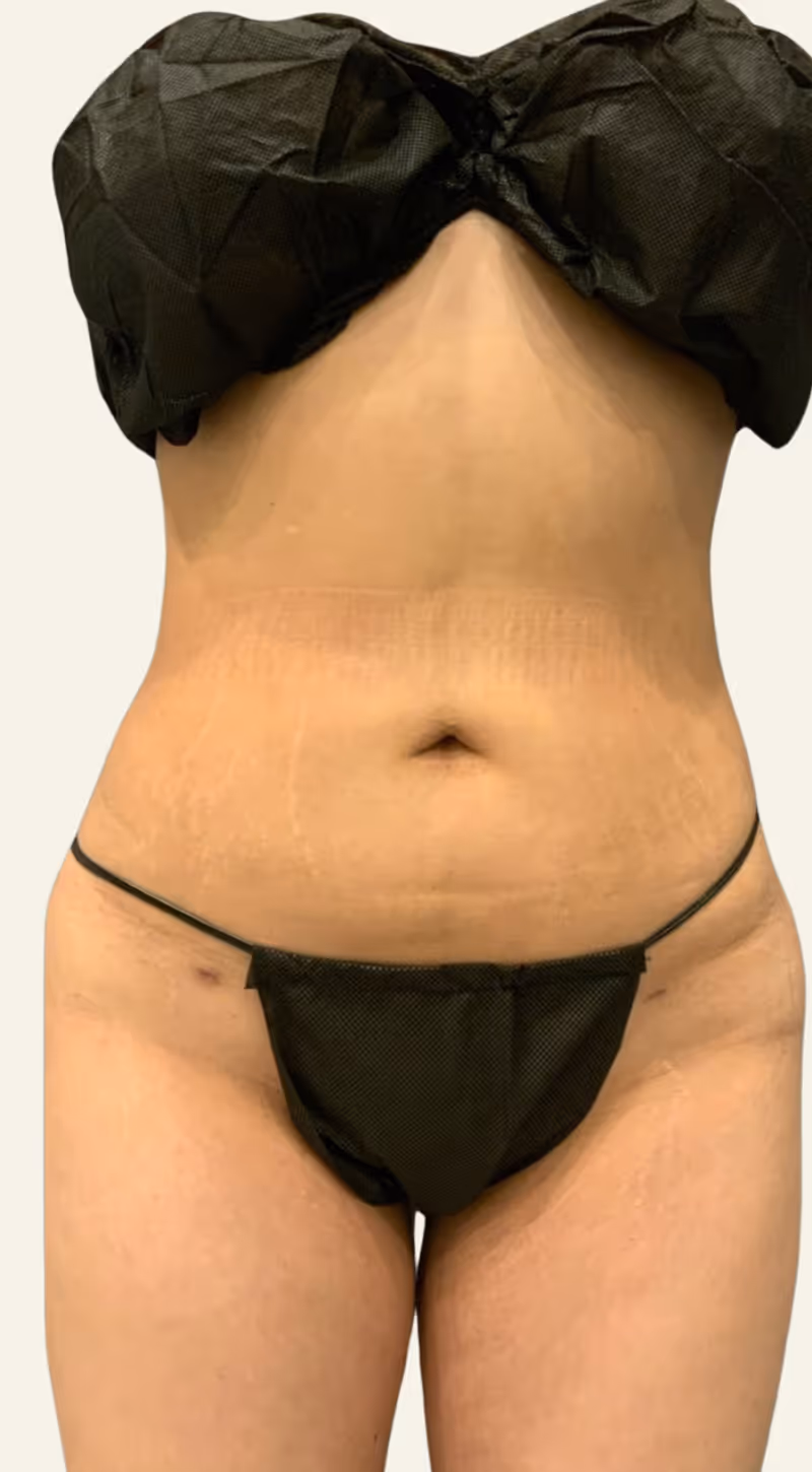 Liposuction Case 2 after view