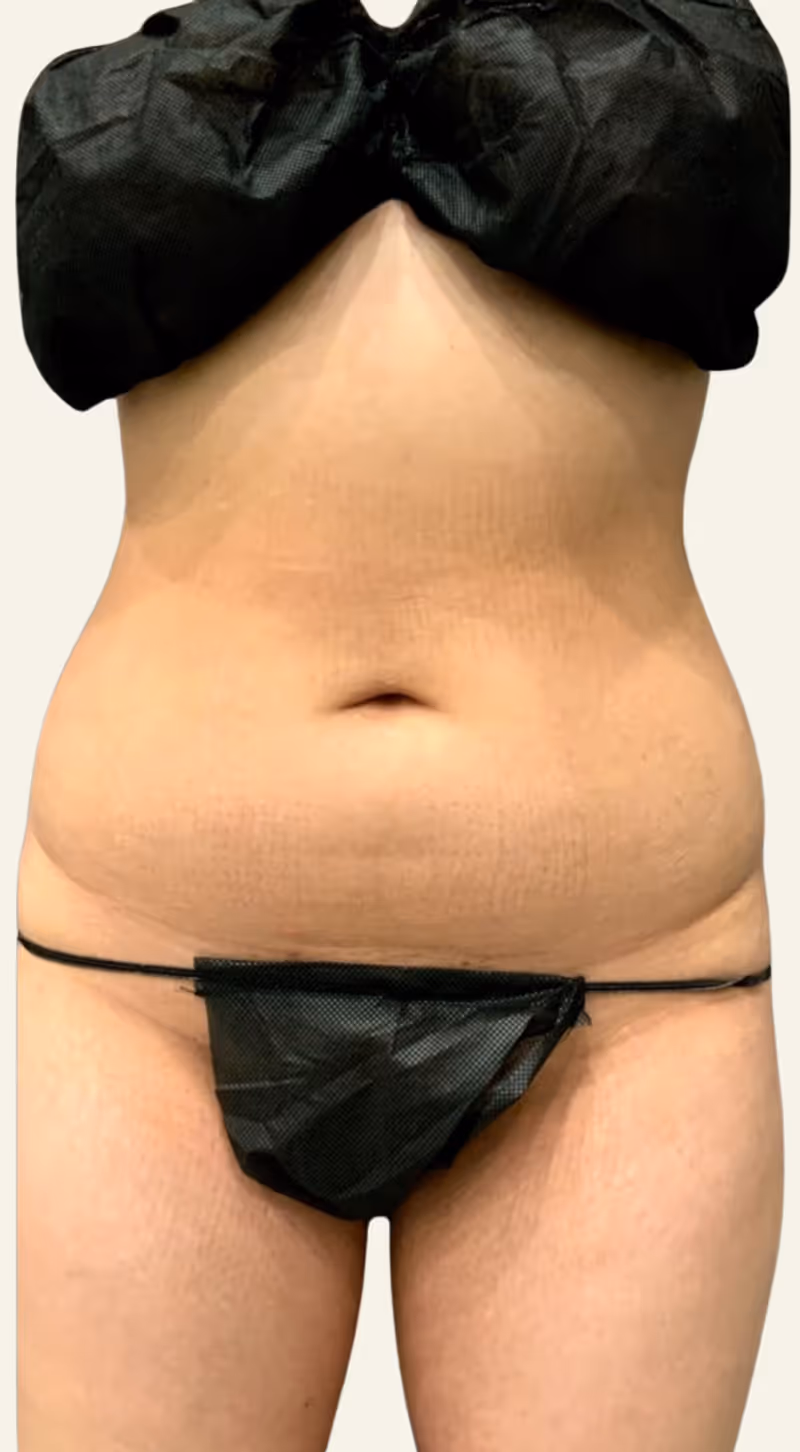 Liposuction Case 2 before view