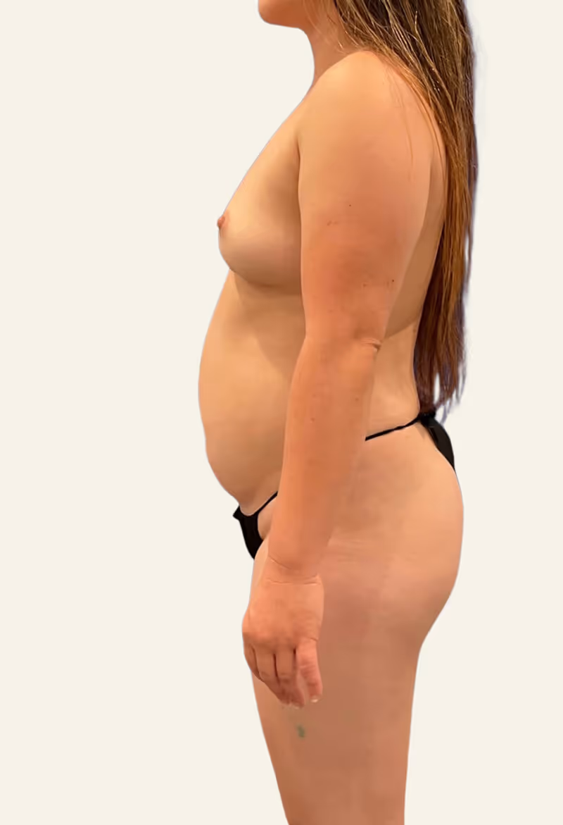 Liposuction Case 20 before view