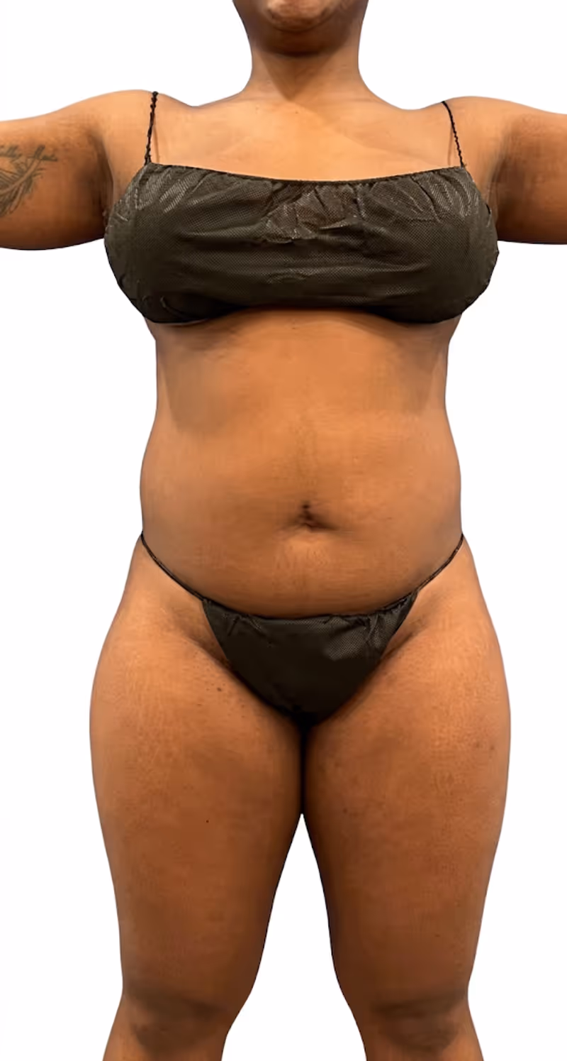 Liposuction Case 21 before view