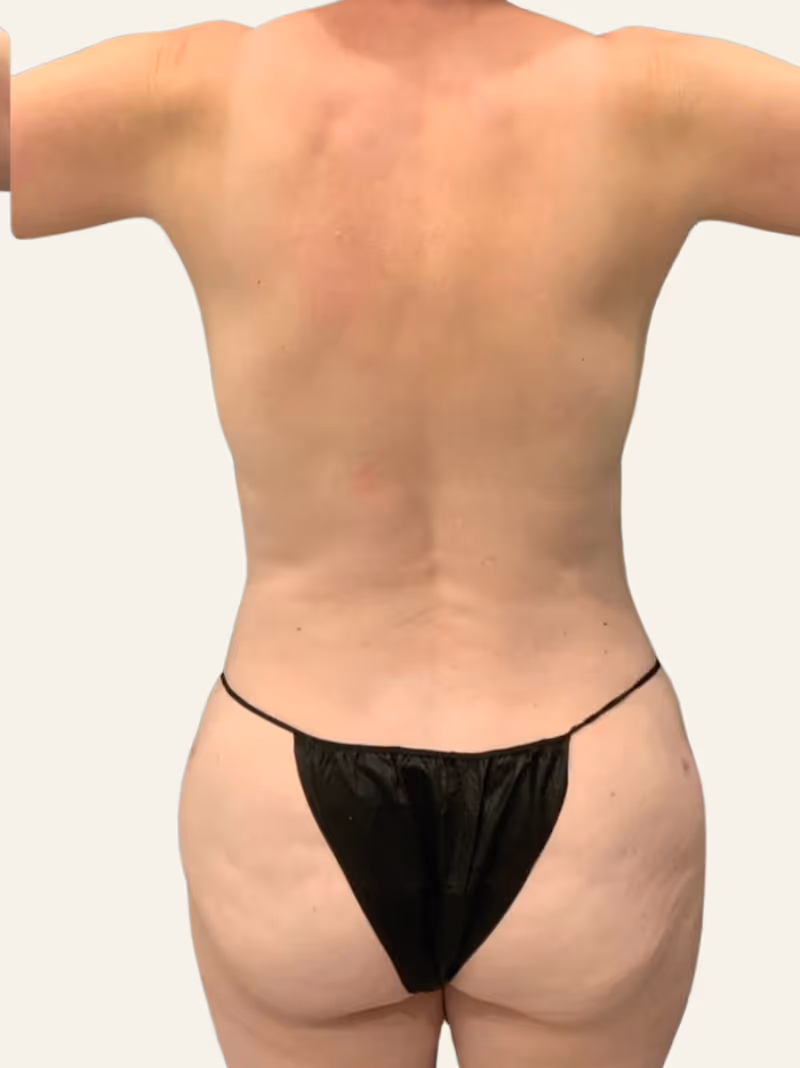 Liposuction Case 3 after view