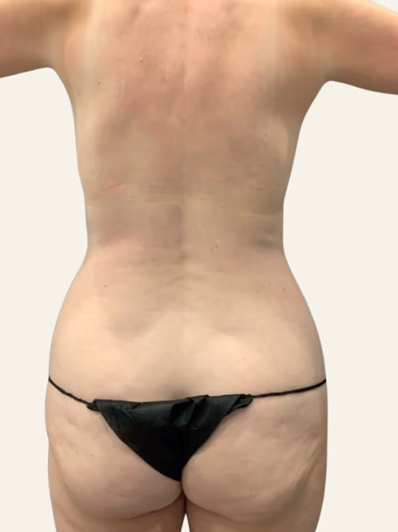 Liposuction Case 3 before view