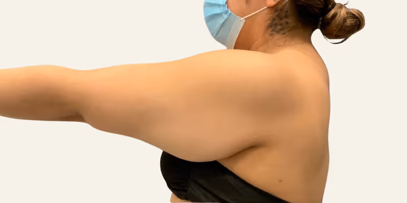 Liposuction Case 4 before view