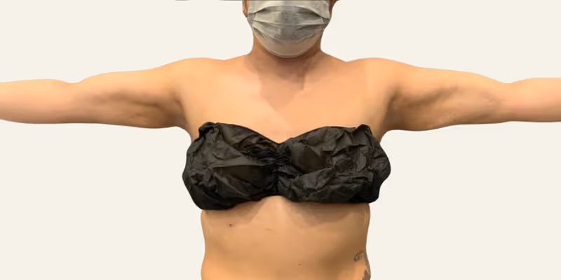Liposuction Case 5 after view