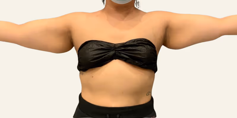 Liposuction Case 5 before view