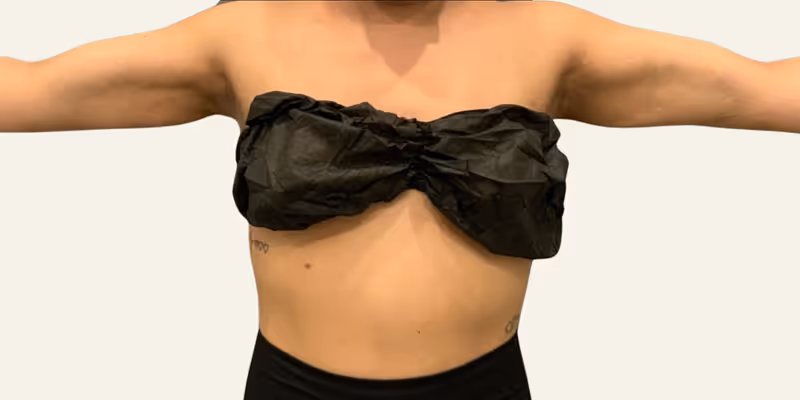 Liposuction Case 6 after view
