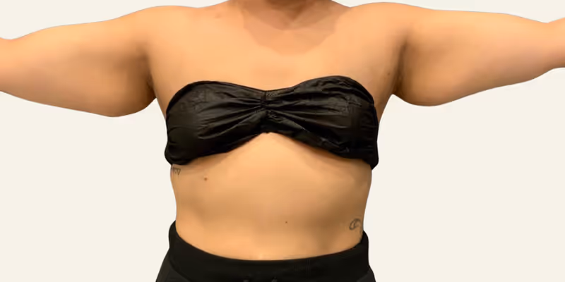 Liposuction Case 6 before view