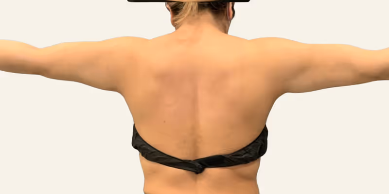 Liposuction Case 7 after view