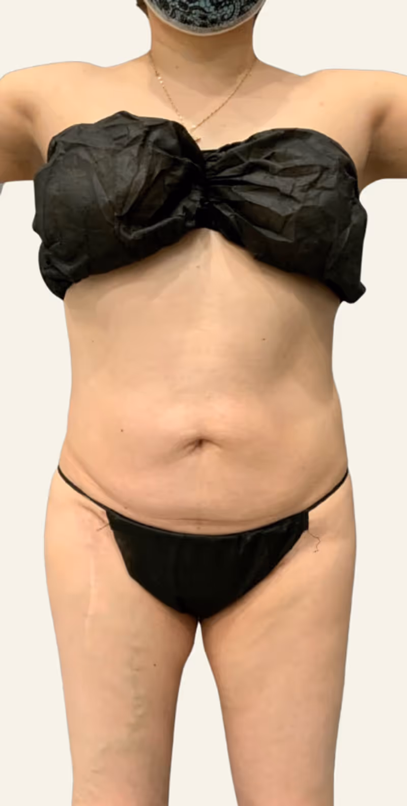 Liposuction Case 8 after view