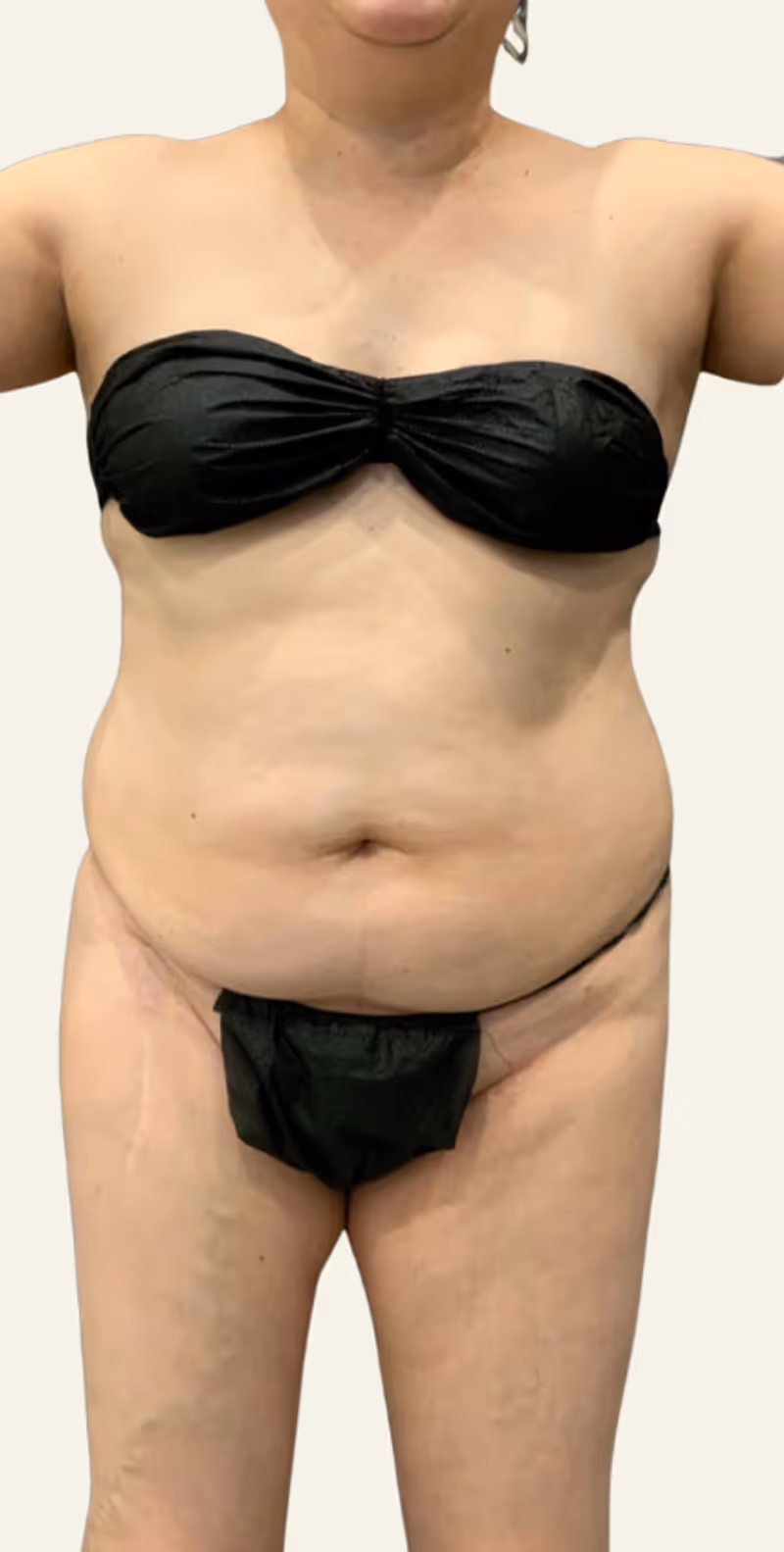 Liposuction Case 8 before view