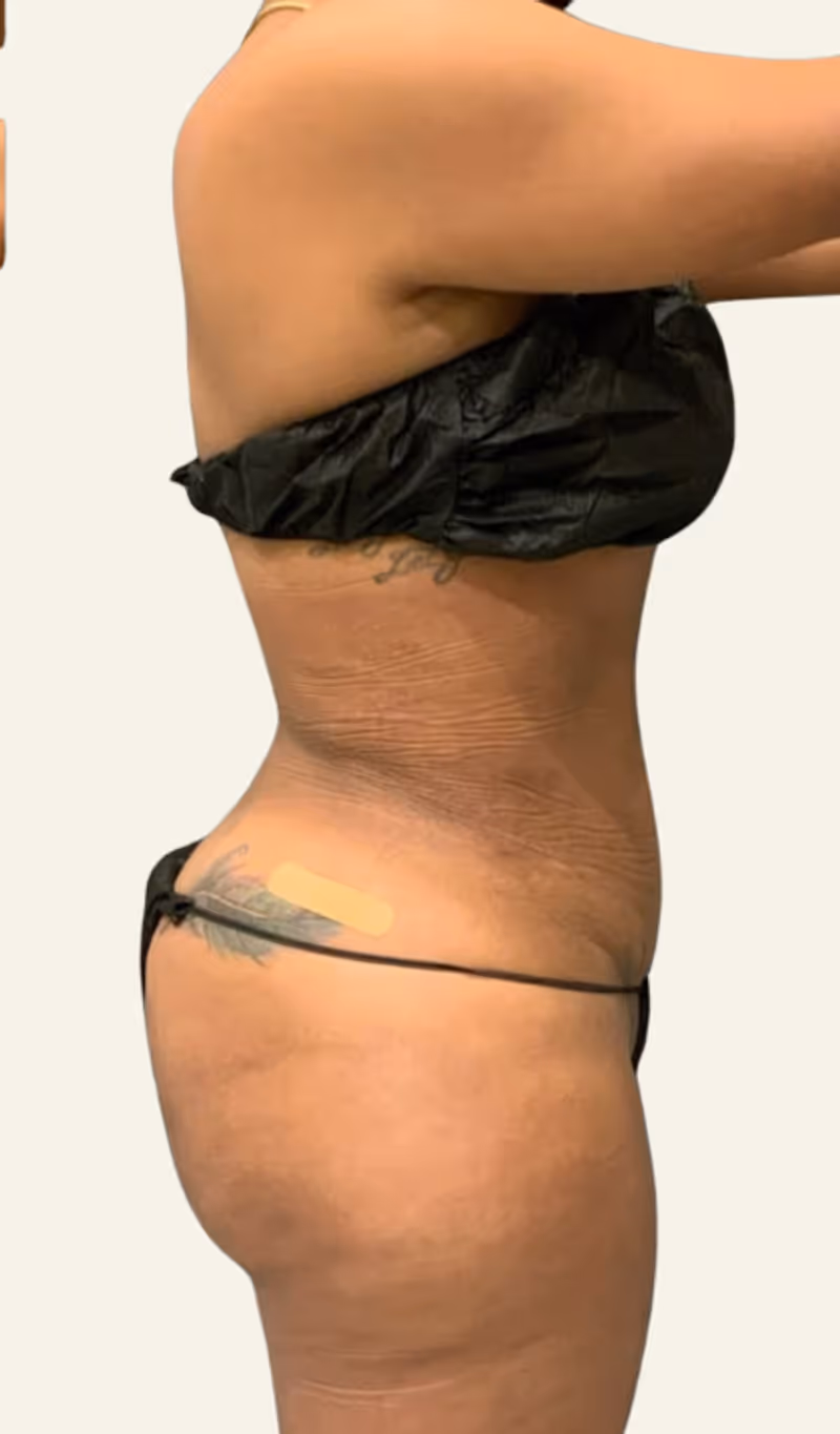 Liposuction Case 9 after view