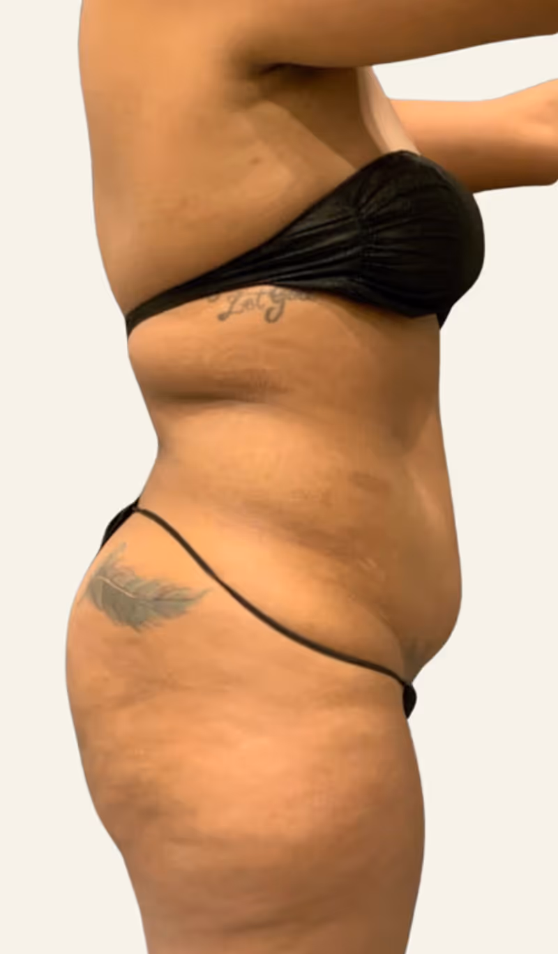 Liposuction Case 9 before view
