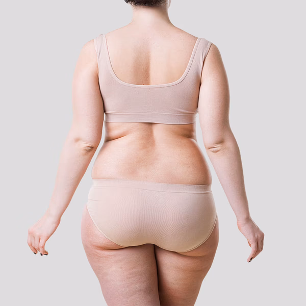 Liposuction Candidate